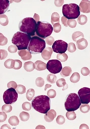 The Acute leukemia card