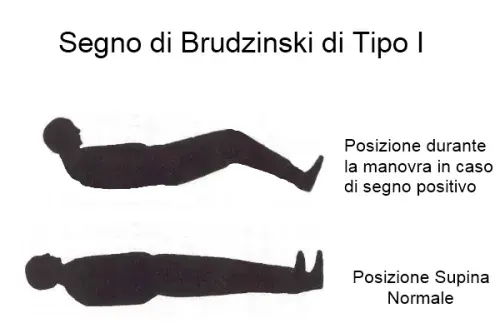 The Brudziński's sign#Brudziński symphyseal sign card