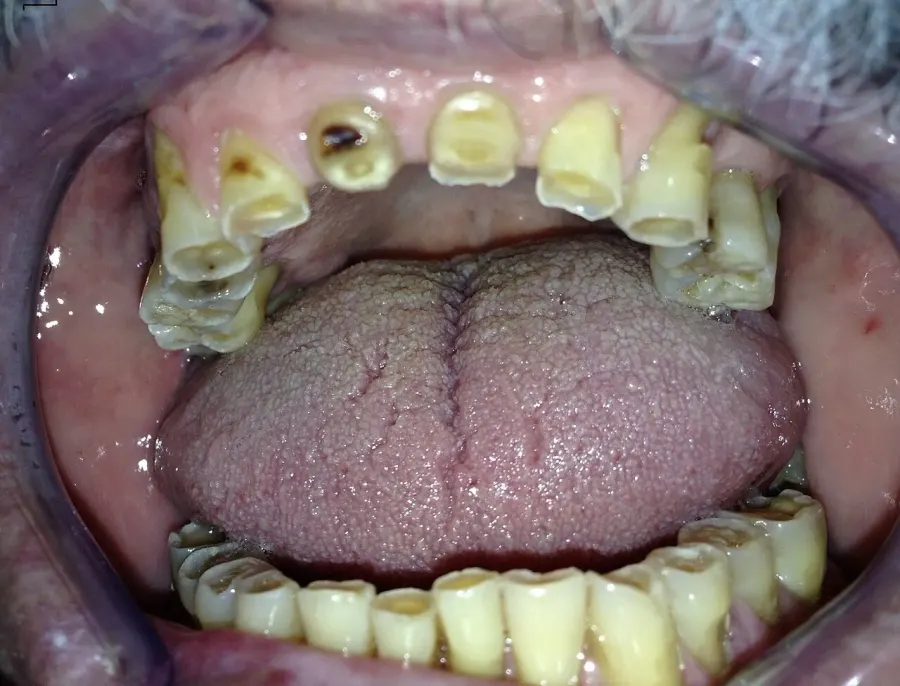 The Bruxism card